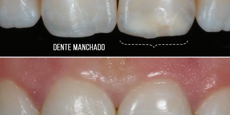 Resina-para-dentes-manchados